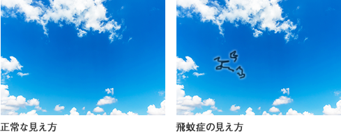 飛蚊症の見え方(イメージ)
