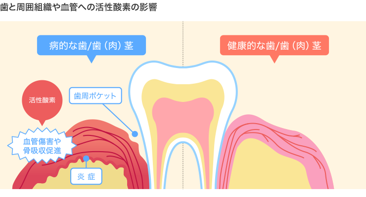 歯と周囲組織や血管への活性酸素の影響